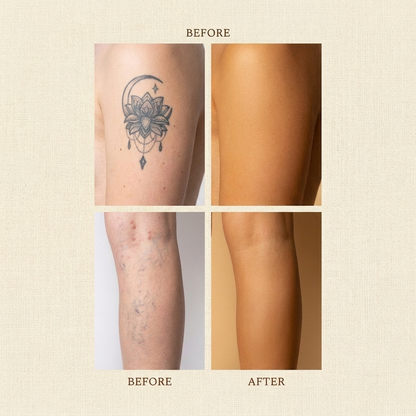 Sundaye® Body Coverage