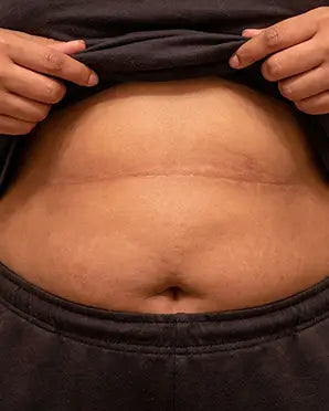 Apron Belly Fold