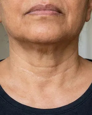 Neck Fold