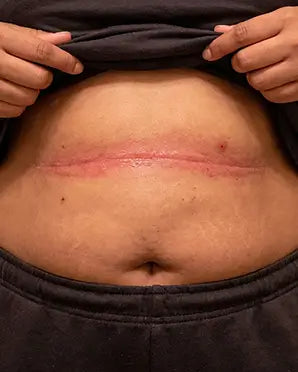Apron Belly Fold