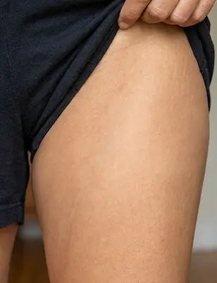 Groin & Inner Thighs