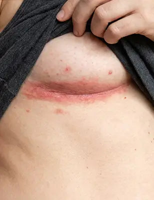 Under-Breast Folds